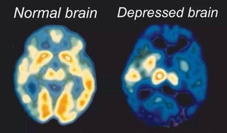 depresja uszkodzenie mózgu
